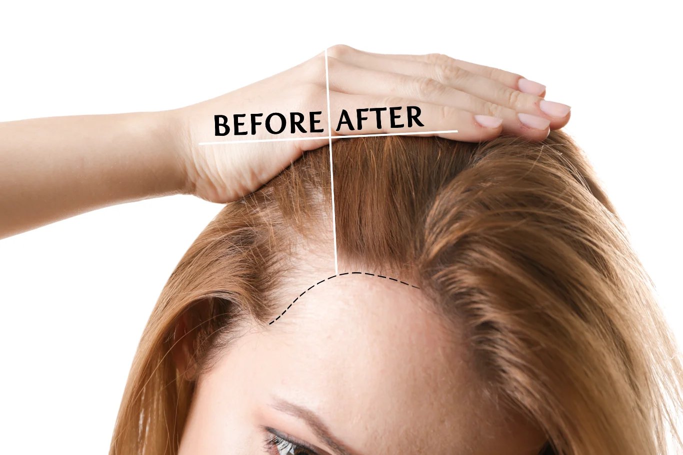 A side by side comparison showing a womans hairline