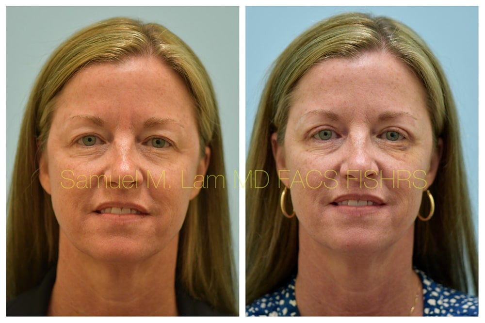 Blepharoplasty Before and After Photo - Dr. Sam Lam - Dallas, TX