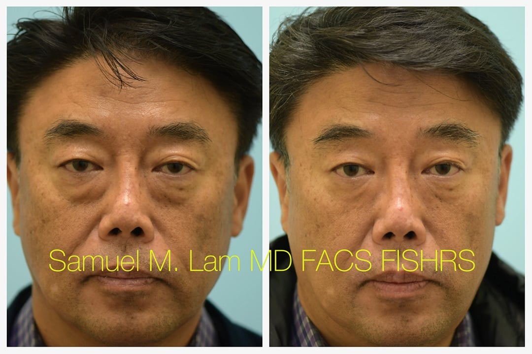 fat grafting blepharoplasty fat grafting blepharoplasty