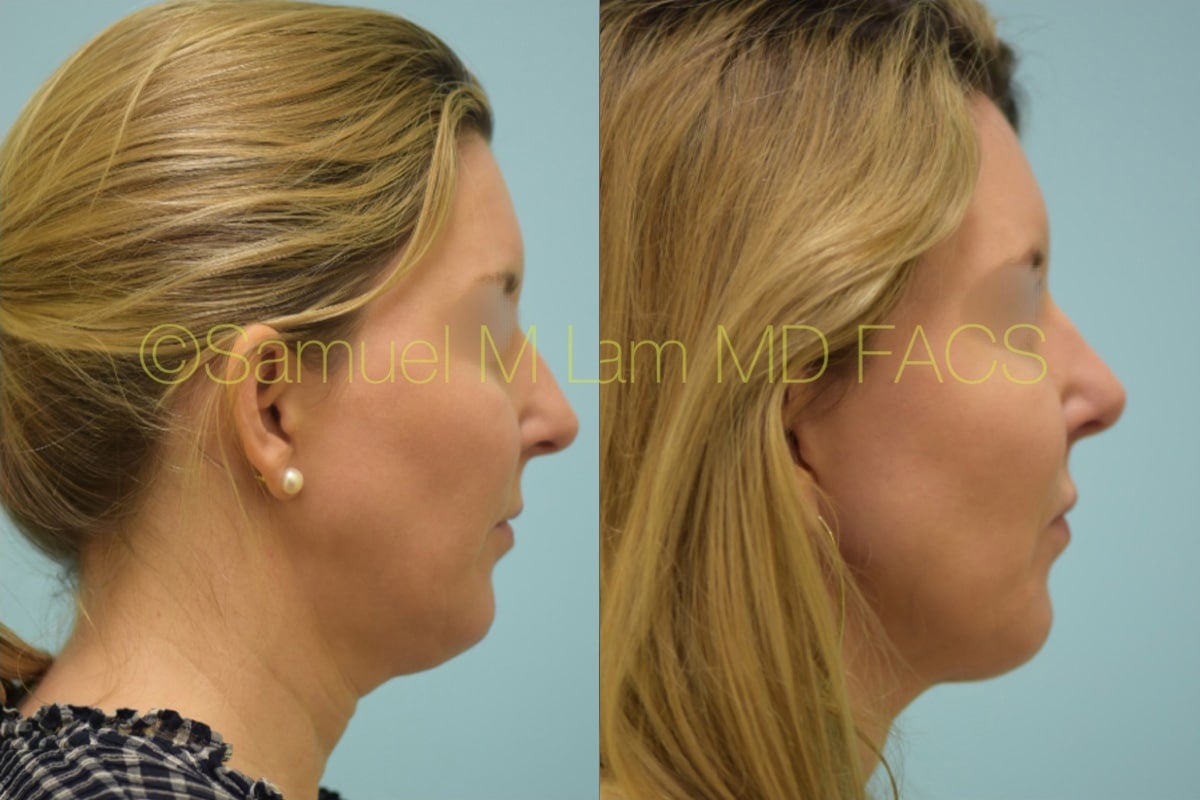 Nasal Tip Rhinoplasty Result Dallas