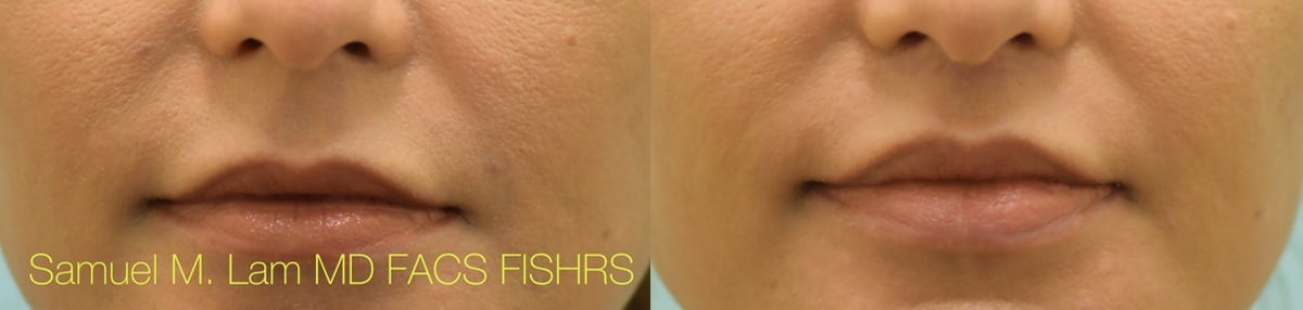 Lip Lift Before and After Photo by Dr. Lam in Plano TX