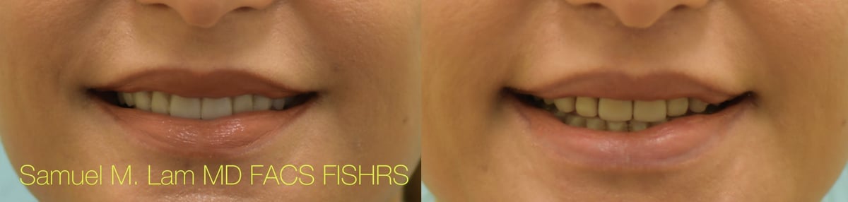 Lip Lift Before and After Photo by Dr. Lam in Plano TX