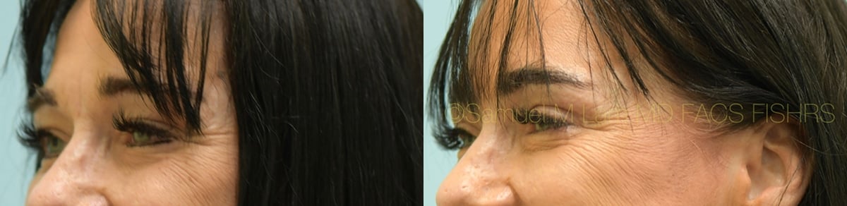Eyelid Rejuvenation Eyelid Rejuvenation