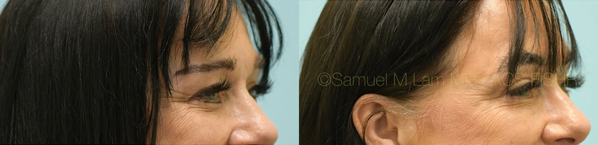 Eyelid Rejuvenation Eyelid Rejuvenation