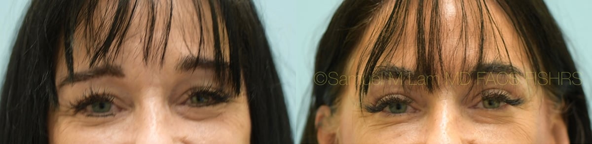 Eyelid Rejuvenation Eyelid Rejuvenation