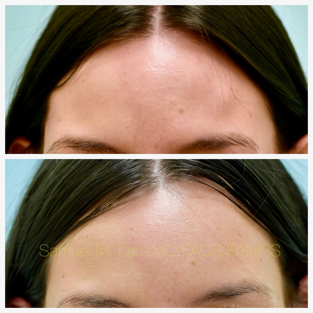 Before After Photos Osteoma Mole Removal Before After Photos Osteoma Mole Removal