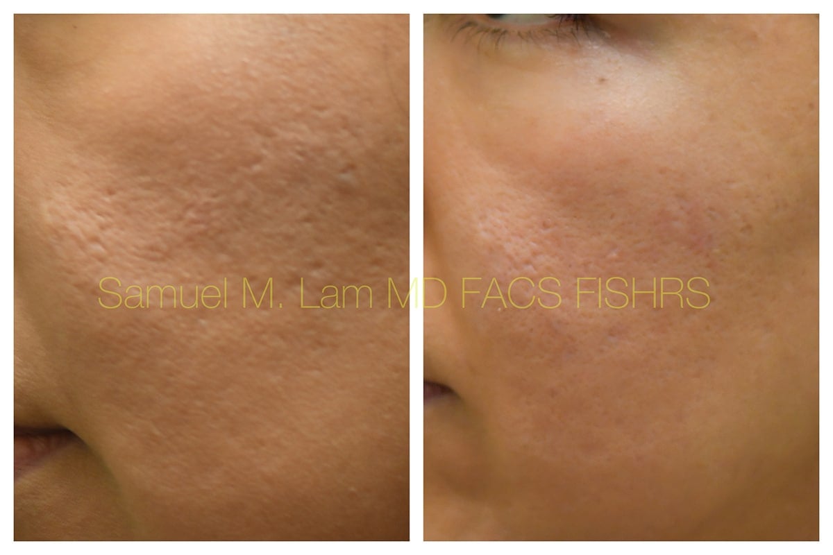 Acne Scarring Before and After Photo by Dr. Lam in Plano TX Acne Scarring Before and After Photo by Dr. Lam in Plano TX