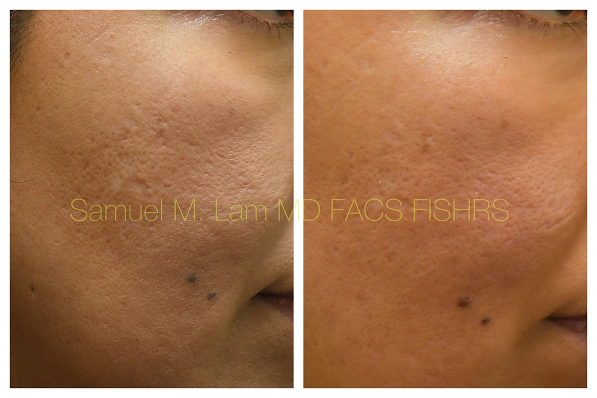 Acne Scarring Before and After Photo by Dr. Lam in Plano TX Acne Scarring Before and After Photo by Dr. Lam in Plano TX
