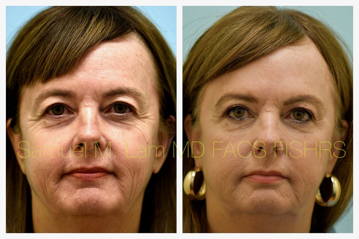Eyelid Rejuvenation Botox and Fillers Before and After Photo by Dr. Lam in Plano TX Eyelid Rejuvenation Botox and Fillers Before and After Photo by Dr. Lam in Plano TX