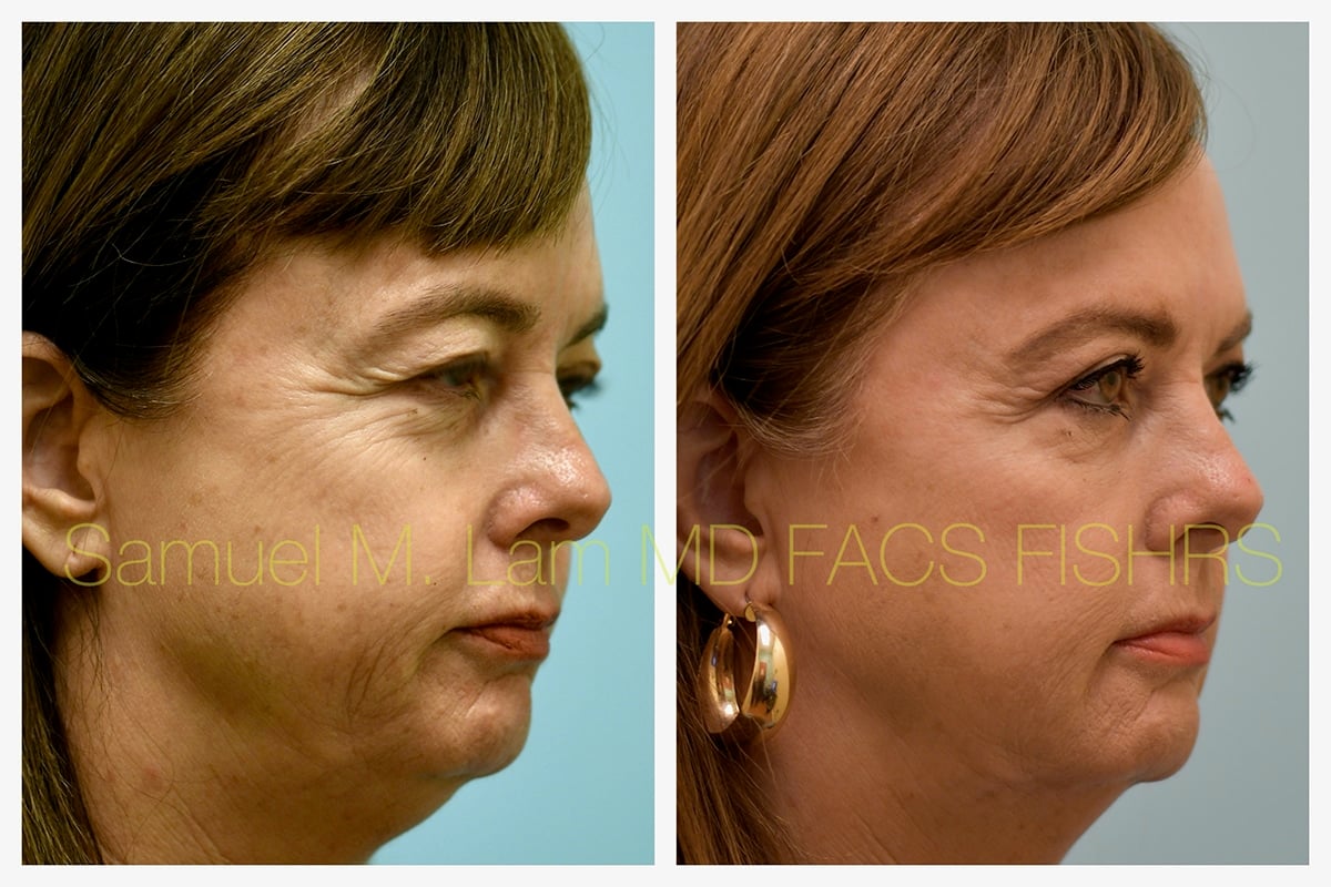 Eyelid Rejuvenation Botox and Fillers Before and After Photo by Dr. Lam in Plano TX Eyelid Rejuvenation Botox and Fillers Before and After Photo by Dr. Lam in Plano TX