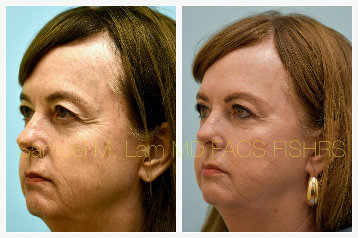 Eyelid Rejuvenation Botox and Fillers Before and After Photo by Dr. Lam in Plano TX Eyelid Rejuvenation Botox and Fillers Before and After Photo by Dr. Lam in Plano TX