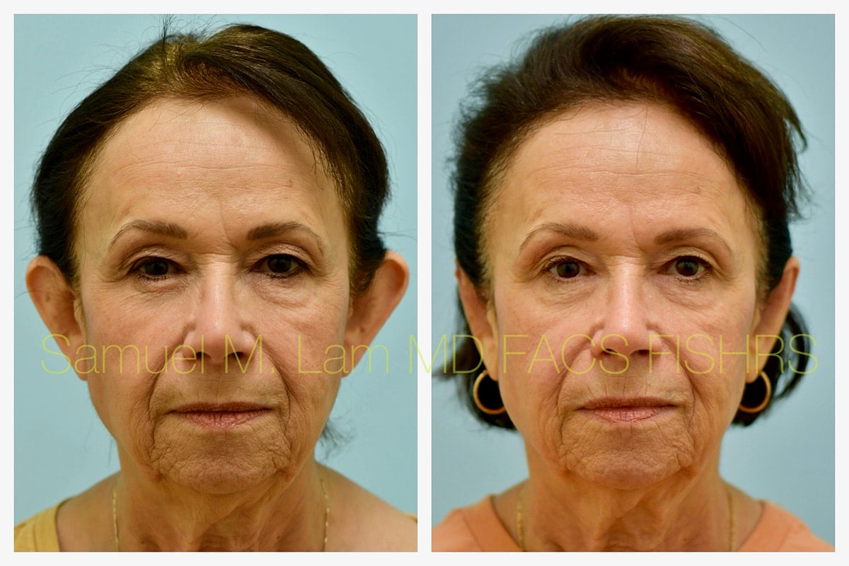 Otoplasty Before and After Photo by Dr. Lam in Plano TX