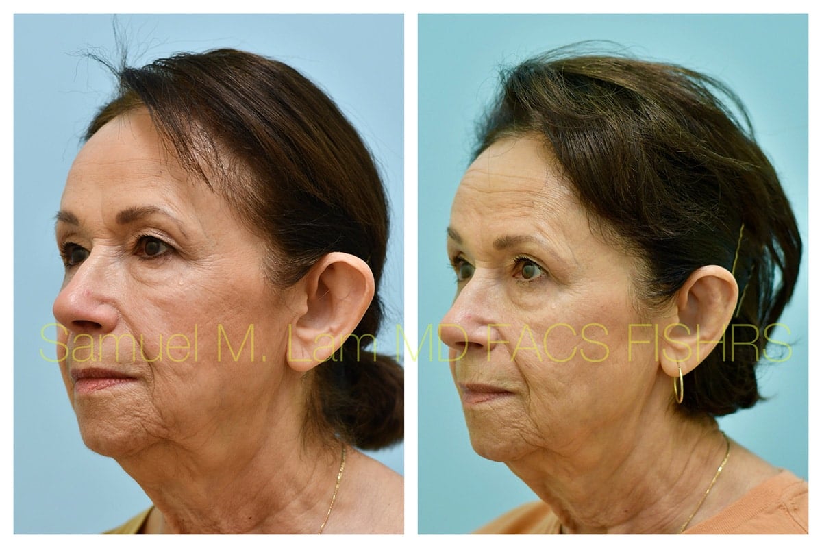 Otoplasty Before and After Photo by Dr. Lam in Plano TX