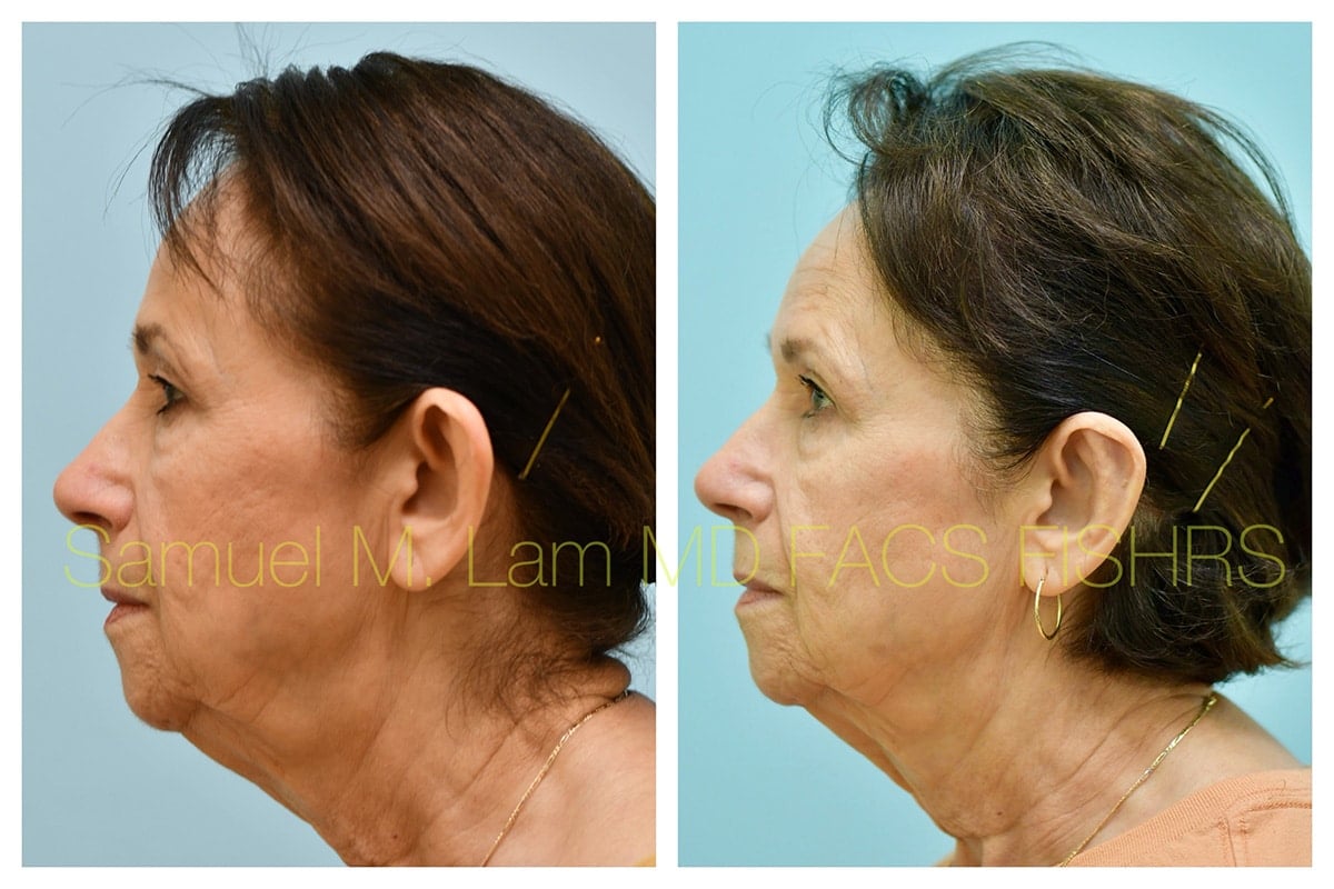 Otoplasty Before and After Photo by Dr. Lam in Plano TX