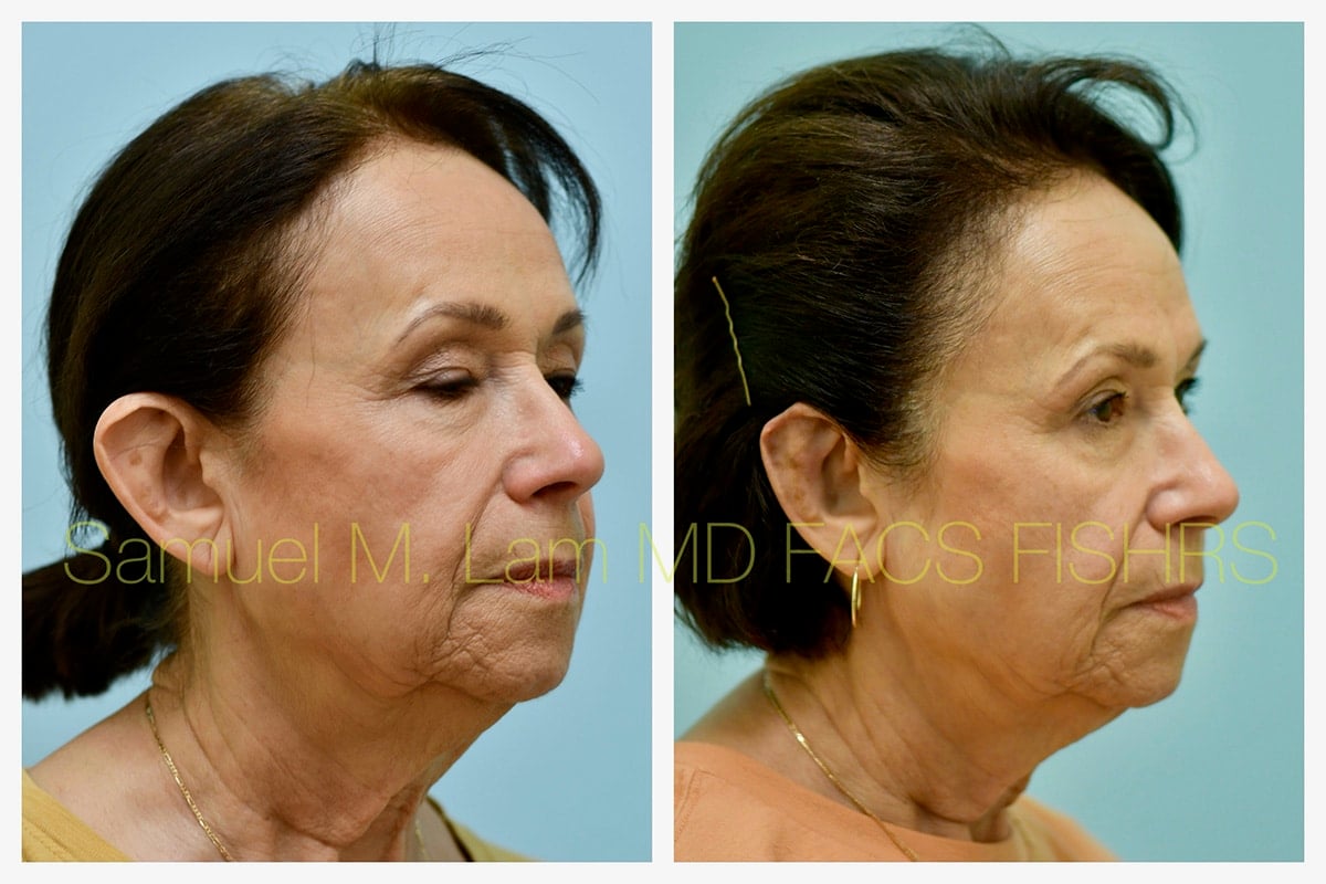 Otoplasty Before and After Photo by Dr. Lam in Plano TX