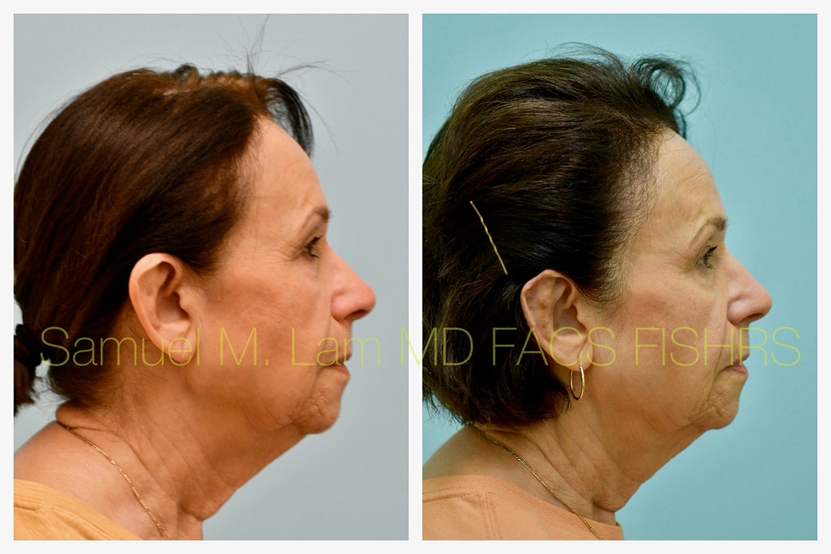 Otoplasty Before and After Photo by Dr. Lam in Plano TX