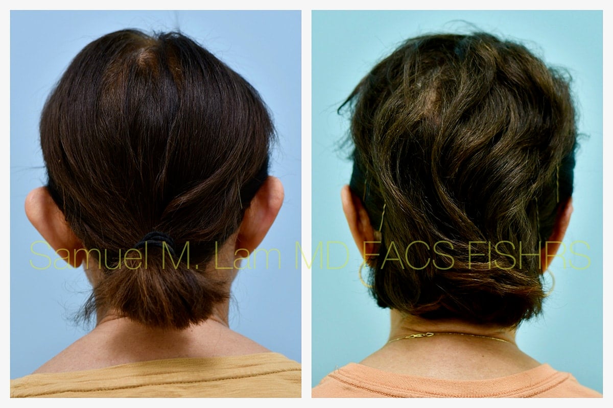 Otoplasty Before and After Photo by Dr. Lam in Plano TX