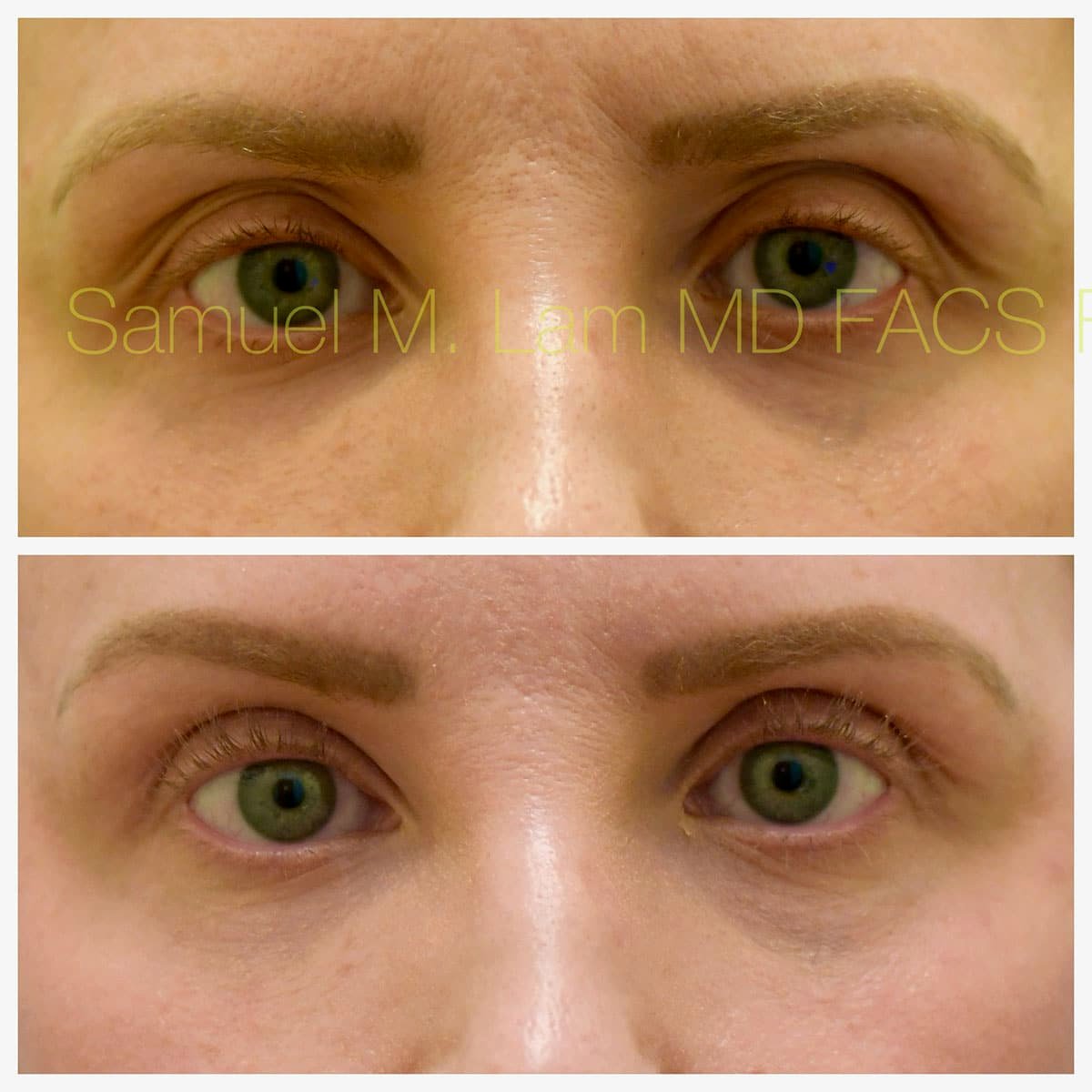 Blepharoplasty eyelid rejuvenation Before and After Photo by Dr. Lam in Plano TX Blepharoplasty eyelid rejuvenation Before and After Photo by Dr. Lam in Plano TX