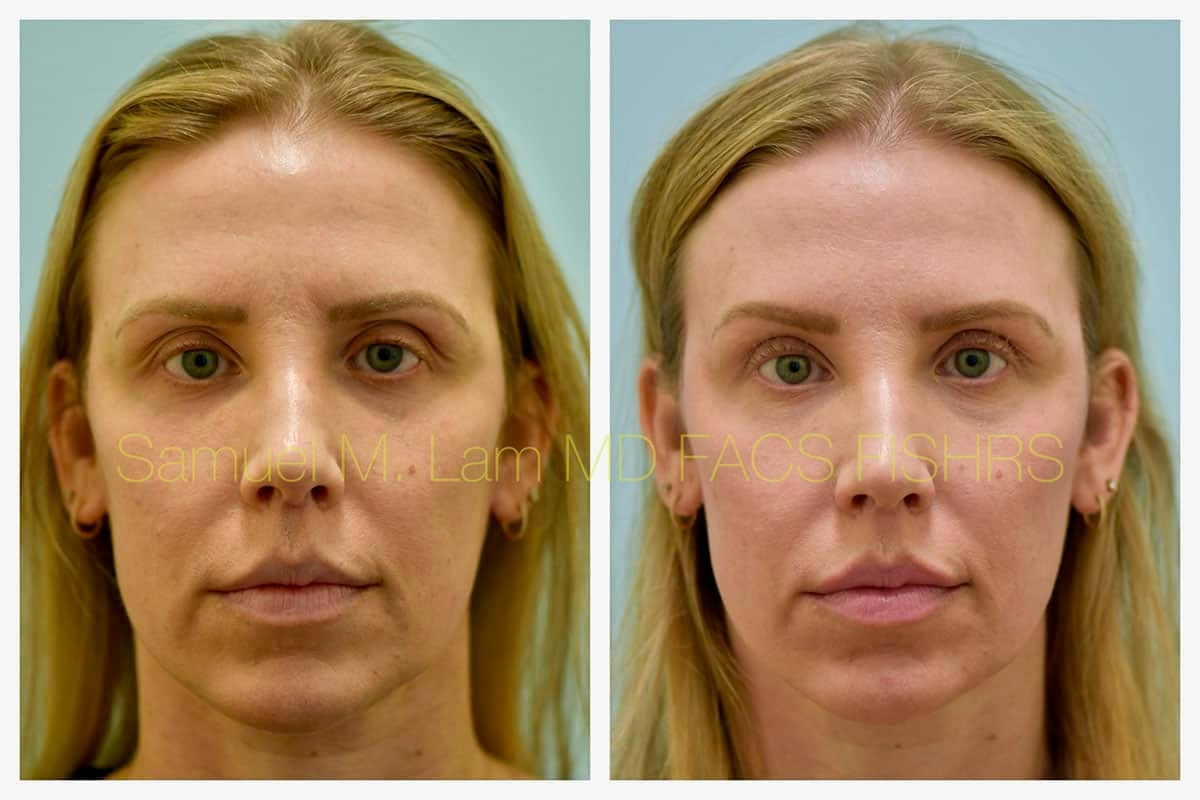 Blepharoplasty eyelid rejuvenation Before and After Photo by Dr. Lam in Plano TX Blepharoplasty eyelid rejuvenation Before and After Photo by Dr. Lam in Plano TX