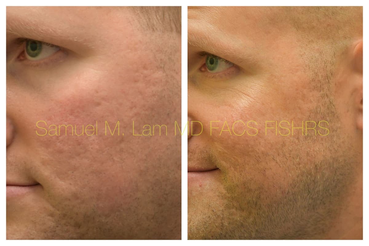 Acne Scarring and MesoBotox Before and After Photo by Dr. Lam in Plano TX Acne Scarring and MesoBotox Before and After Photo by Dr. Lam in Plano TX