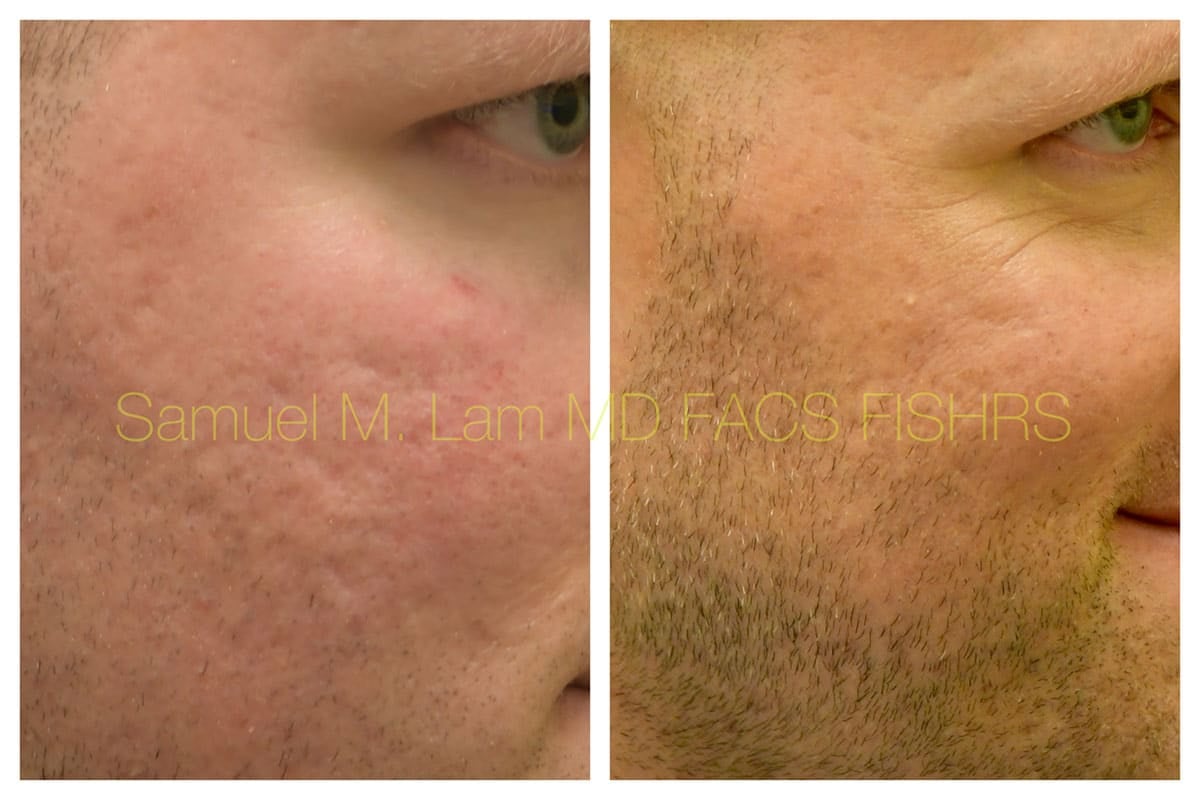 Acne Scarring and MesoBotox Before and After Photo by Dr. Lam in Plano TX Acne Scarring and MesoBotox Before and After Photo by Dr. Lam in Plano TX