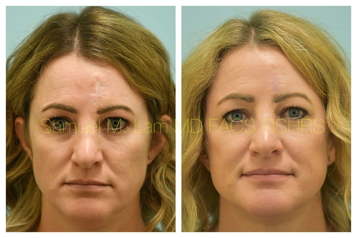 Scar Revision Before and After Photo by Dr. Lam in Plano TX of