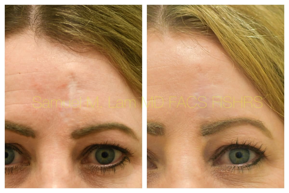 Scar Revision Before and After Photo by Dr. Lam in Plano TX of