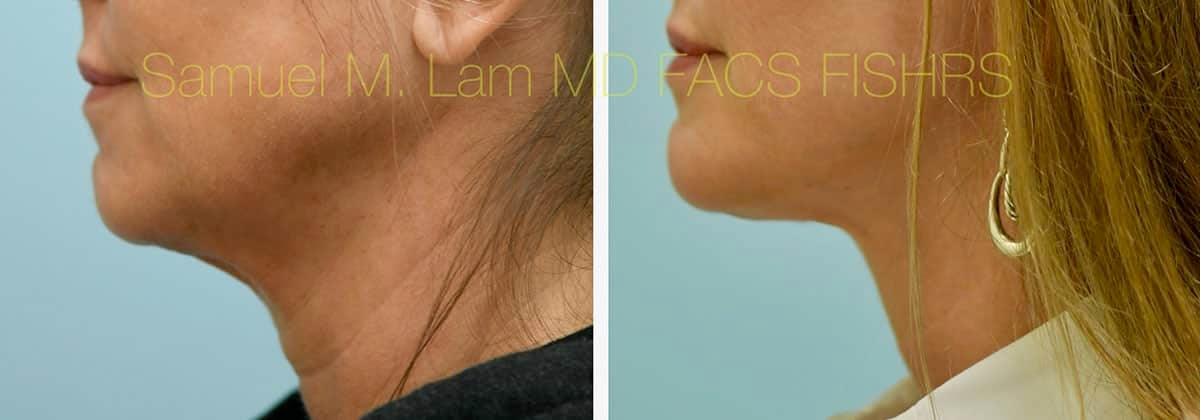 Face:Neck Lift Before and After Photo by Dr. Lam in Plano, TX