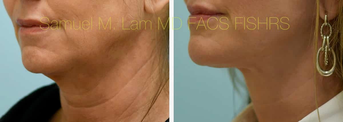 Face:Neck Lift Before and After Photo by Dr. Lam in Plano, TX