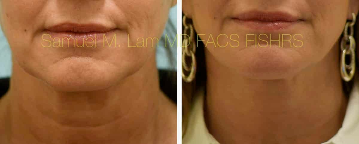 Face:Neck Lift Before and After Photo by Dr. Lam in Plano, TX