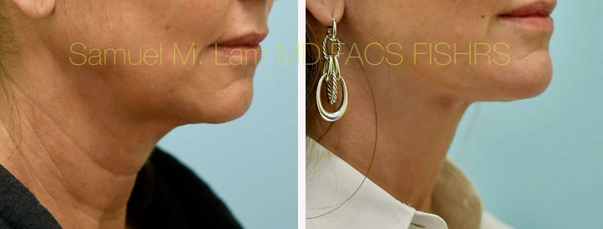 Face:Neck Lift Before and After Photo by Dr. Lam in Plano, TX