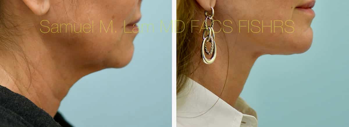 Face:Neck Lift Before and After Photo by Dr. Lam in Plano, TX