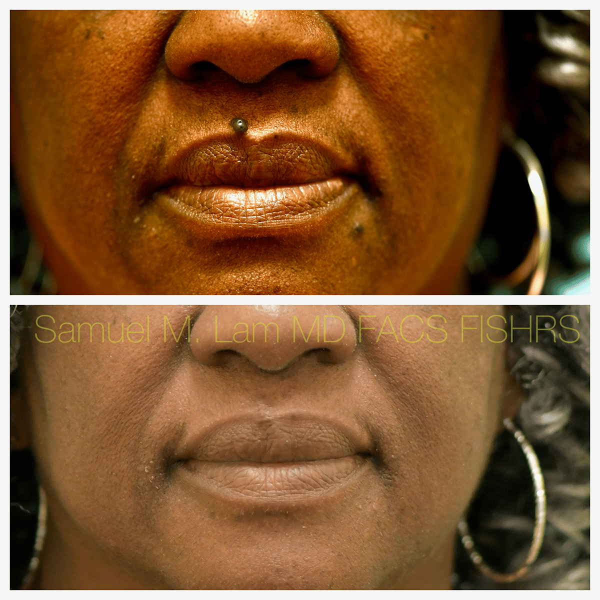 Mole Removal Before and After Photo by Dr. Lam in Plano TX