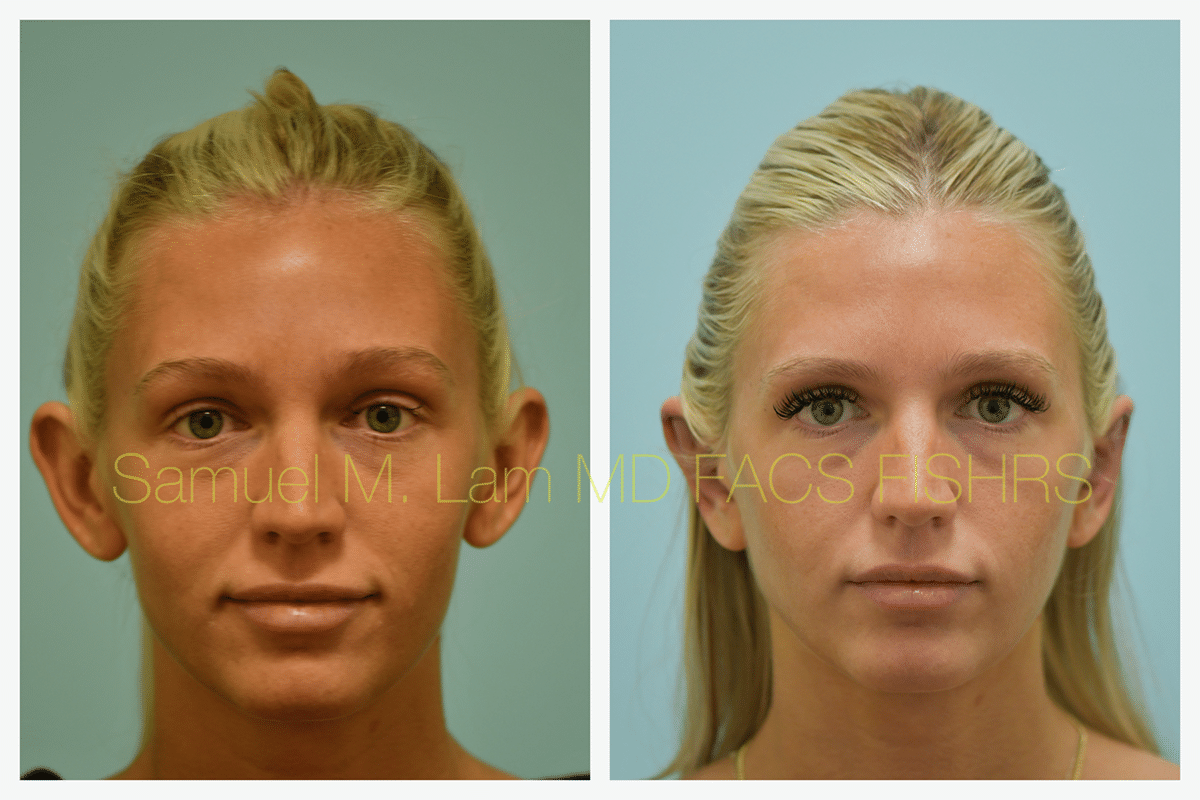 Otoplasty Before and After Photo by Dr. Lam in Plano TX