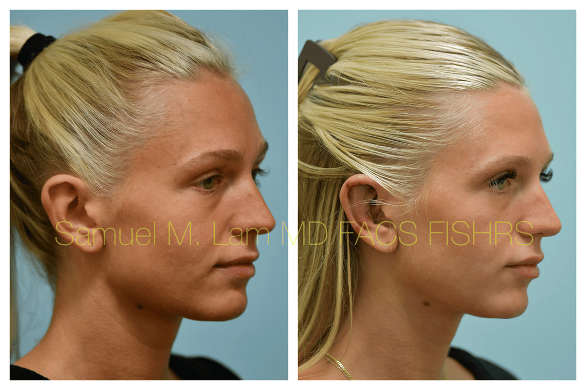 Otoplasty Before and After Photo by Dr. Lam in Plano TX