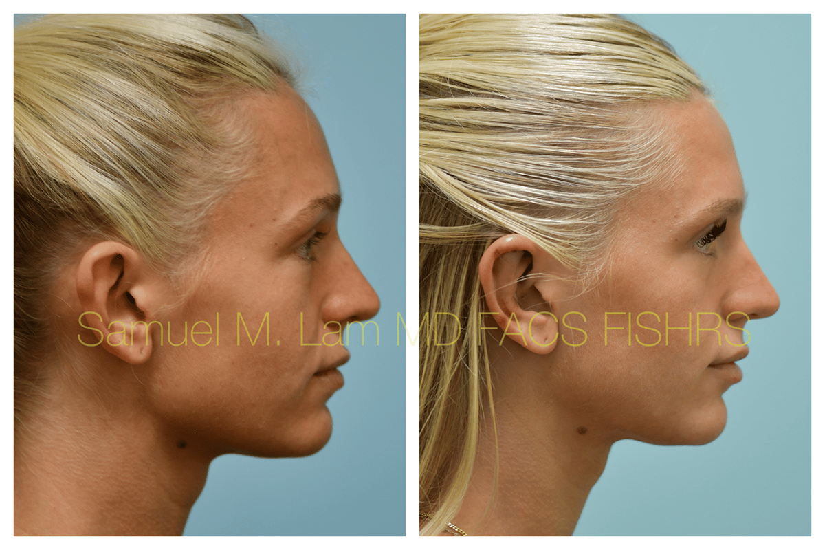 Otoplasty Before and After Photo by Dr. Lam in Plano TX