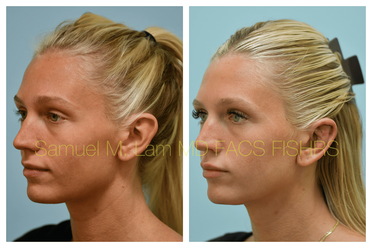 Otoplasty Before and After Photo by Dr. Lam in Plano TX