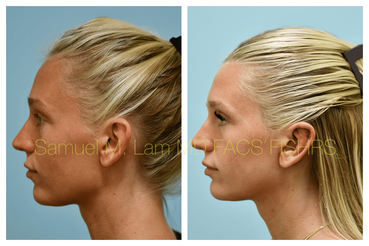 Otoplasty Before and After Photo by Dr. Lam in Plano TX