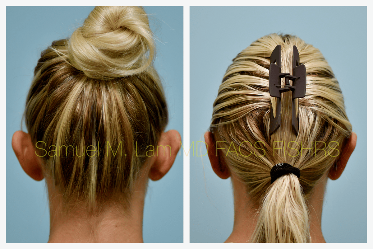 Otoplasty Before and After Photo by Dr. Lam in Plano TX
