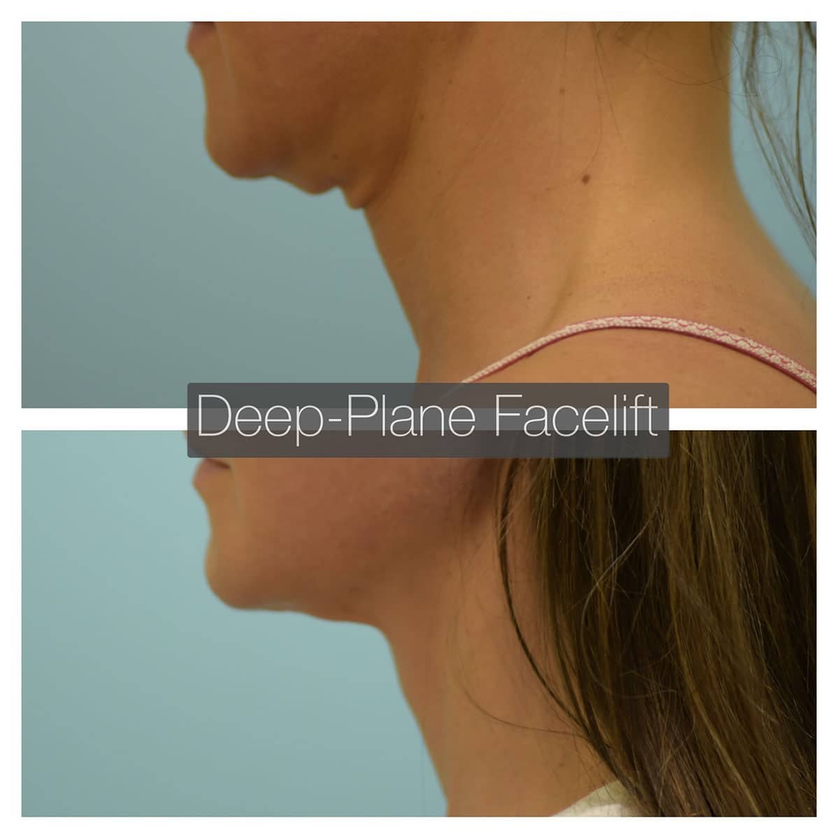 Deep Plane Facelift Before and After Photo by Dr. Lam in Plano TX