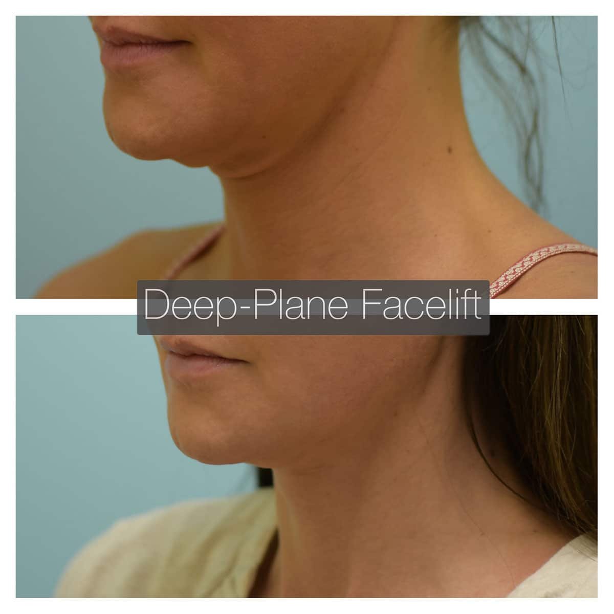 Deep Plane Facelift Before and After Photo by Dr. Lam in Plano TX