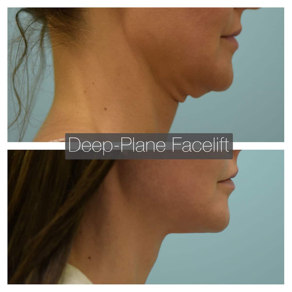 Deep Plane Facelift Before and After Photo by Dr. Lam in Plano TX