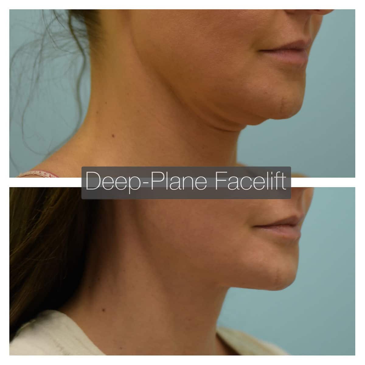 Deep Plane Facelift Before and After Photo by Dr. Lam in Plano TX
