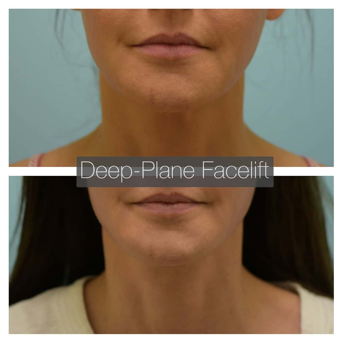 Deep Plane Facelift Before and After Photo by Dr. Lam in Plano TX