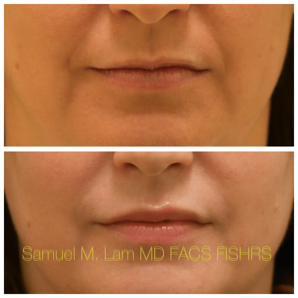 Lip Filler Before and After Photo by Dr. Lam in Plano TX Lip Filler Before and After Photo by Dr. Lam in Plano TX
