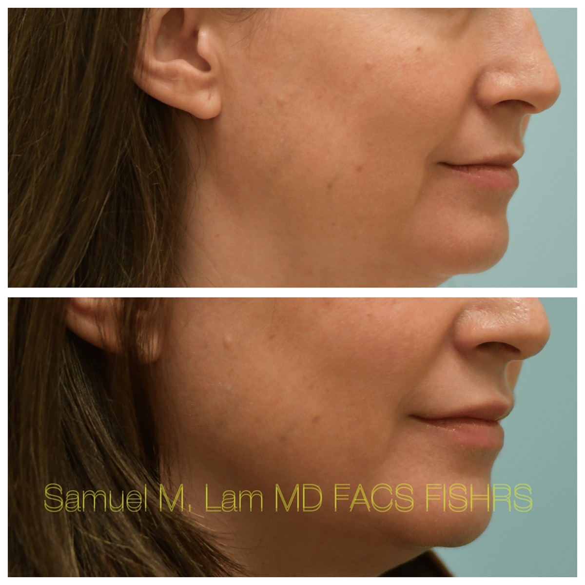 Lip Filler Before and After Photo by Dr. Lam in Plano TX Lip Filler Before and After Photo by Dr. Lam in Plano TX