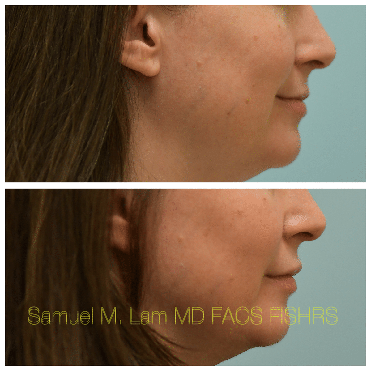 Lip Filler Before and After Photo by Dr. Lam in Plano TX Lip Filler Before and After Photo by Dr. Lam in Plano TX