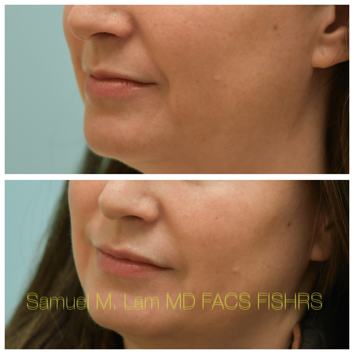Lip Filler Before and After Photo by Dr. Lam in Plano TX Lip Filler Before and After Photo by Dr. Lam in Plano TX