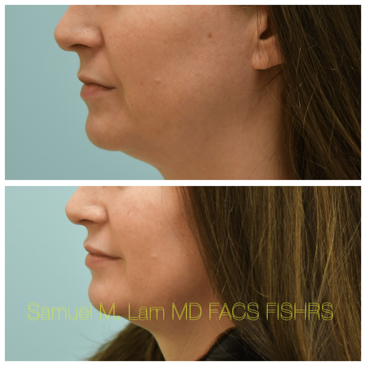 Lip Filler Before and After Photo by Dr. Lam in Plano TX Lip Filler Before and After Photo by Dr. Lam in Plano TX