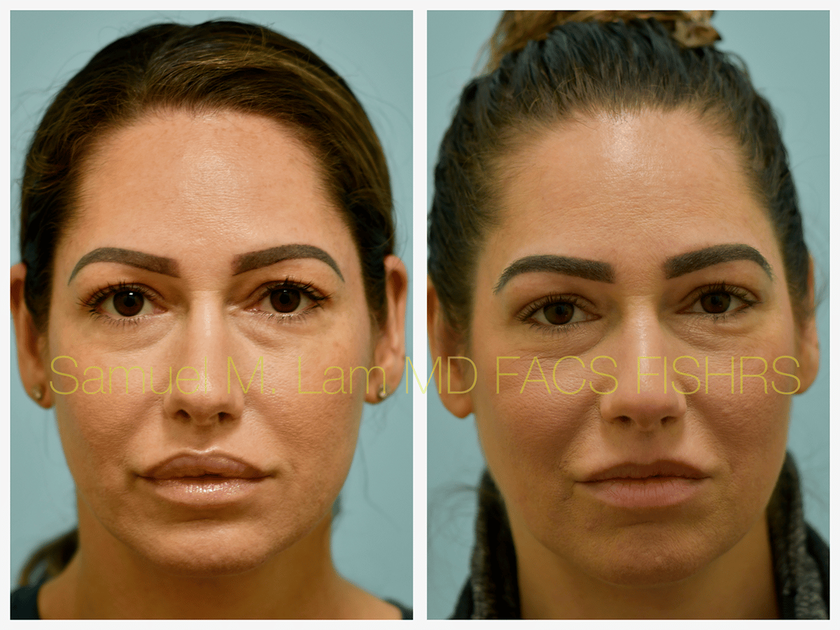 Lip Reduction Before and After Photo by Dr. Lam in Plano TX